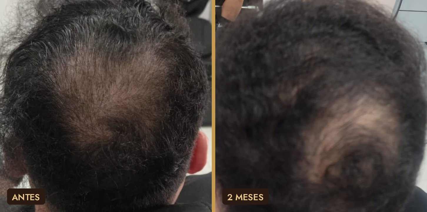 Antes e depois de tratamento capilar Tricho Control na região da coroa
